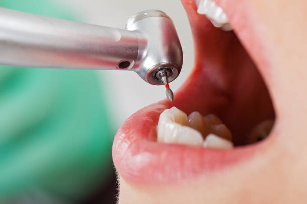 Best Emergency Tooth Extraction in Big Coppitt Key, FL
